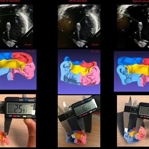 Two Dimensional Echocardiographic Apical 4 Chamber View Measurements