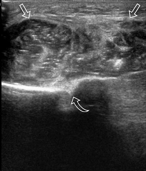 Soft Tissue Ultrasonography Longitudinal Plane Demonstrating A