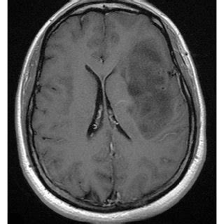 A Contrast Enhanced T1 Weighted Image Shows A Butterfly Glioblastoma