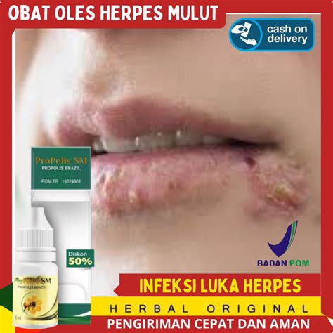 Jual Salep Herpes Genital Obat Oles Untuk Herpes Di Bibir Muncul