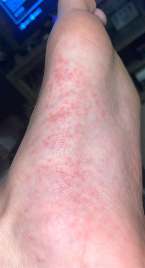 Have had itchy feet in the bottom/middle area of the foot (both feet