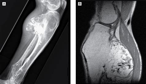 Familial History Of Bone Tumors Genetics And Genomics Jama Jama