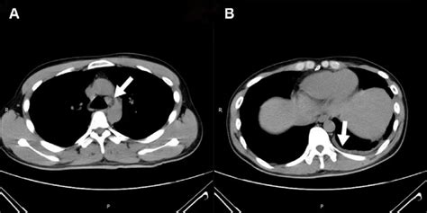 (A) Arrow shows mediastinal adenopathy, and (B) arrow shows mild left ...