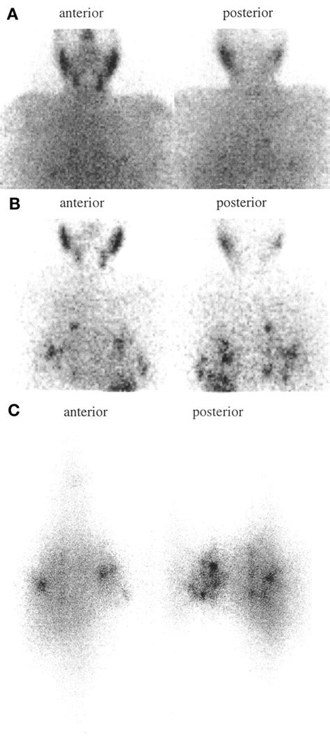 Comparison Of I Scintigraphy At And Hours In Patients With