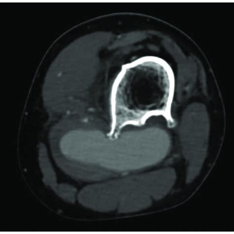 Axial Computed Tomography Angiography Revealed Popliteal Artery