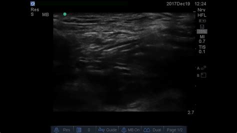 Usg Guided Femoral Nerve Block Youtube