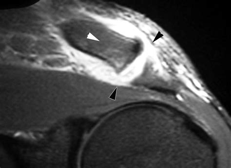 Mr Imaging Appearances Of Acromioclavicular Joint Dislocation