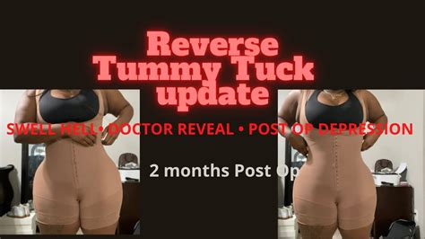 Reverse Tummy Tuck Update Months Post Op Post Op Depression