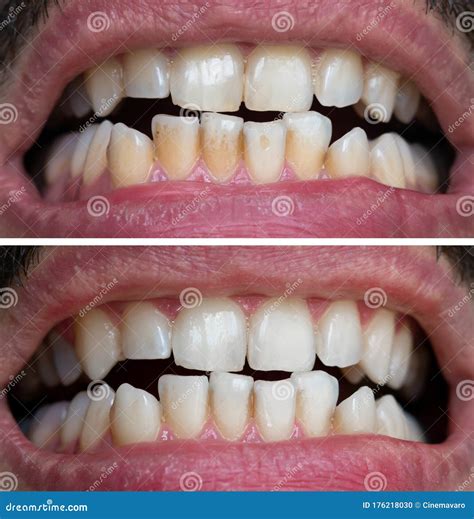 Natural Teeth Bleaching Teeth Before And After Whitening Dental Care