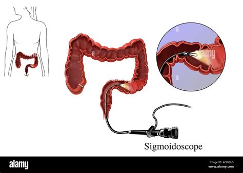 Differenza Tra Colonscopia Rettoscopia Sigmoidoscopia Anoscopia Porn