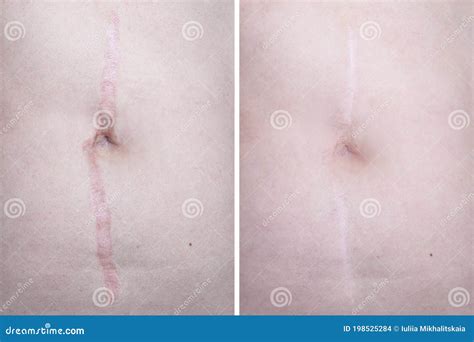 Hypertrophic Keloid Scar on Woman Stomach before and after Laser ...