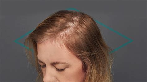 Alopecia En Mujeres Tipos De Alopecia Femenina Causas