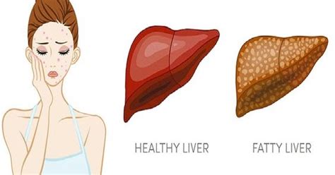 6 Clear Warning Signs Your Liver Is Full Of Toxins And Making You Fat