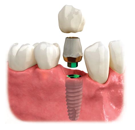 Dental Implants In Tampa Weninger Dentistry