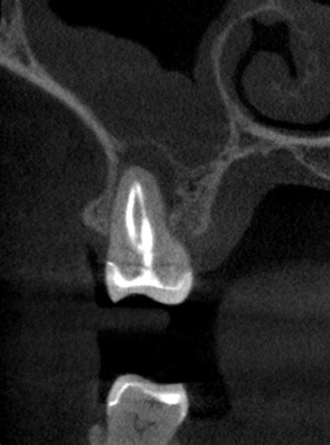 Maxillary Sinusitis Of Endodontic Origin MSEO Seattle Endodontics