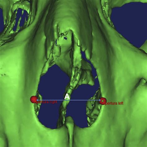 Skeletal Nasal Parameters The Piriform Aperture Width Paw Is The