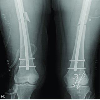 (a and b) Post-operative radiograph of both femur at 1 year showing ...