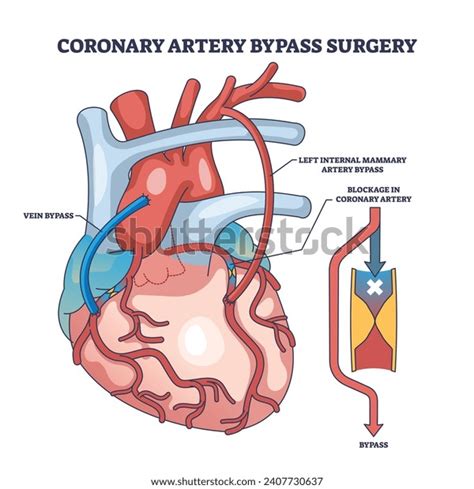 231 Arterial Blockage Problem Images, Stock Photos, 3D objects ...