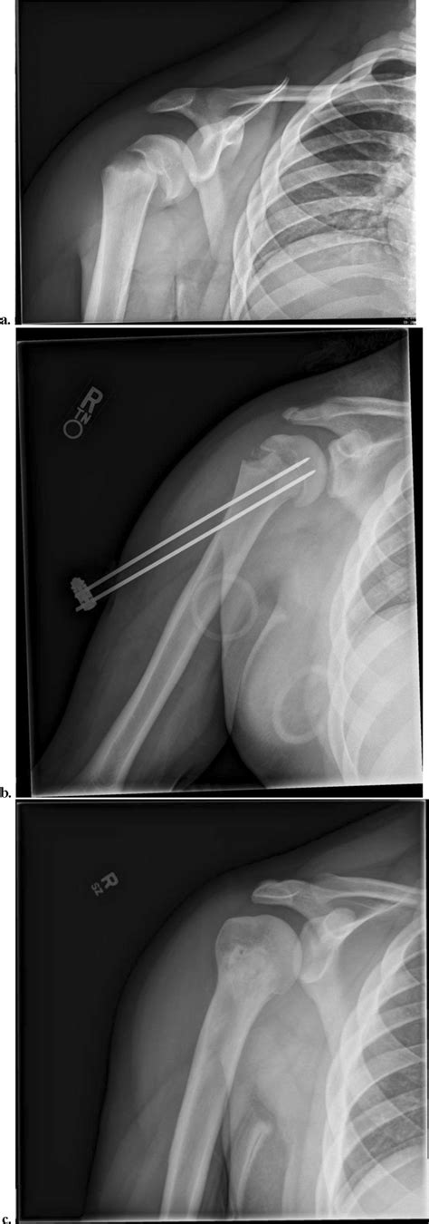 Operative Management Of Proximal Humerus Fractures A This Is A