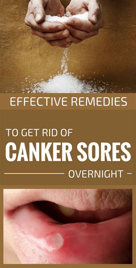 Effective Remedies To Get Rid Of Canker Sores Overnight Healthy Beauty Ways Canker Sore