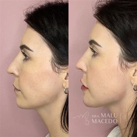 Harmoniza O Facial Dra Malu Macedo Agende Sua Avalia O