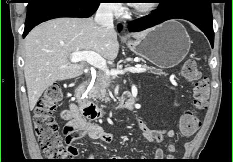 Pancreatic Cancer Encases The Pv Smv Splenic Vein Confluence Pancreas