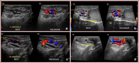 Doppler Ultrasound Of The Scrotal Vessels Taken From Patients With Download Scientific Diagram