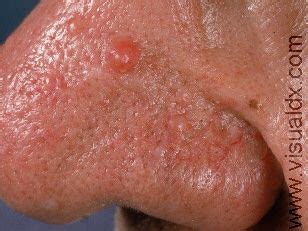 Fibrous Papule of Nose | Nose, Image, Health