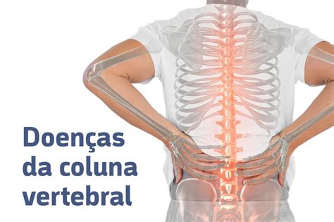 Doenças Da Coluna Vertebral Guia Saúde Cidades