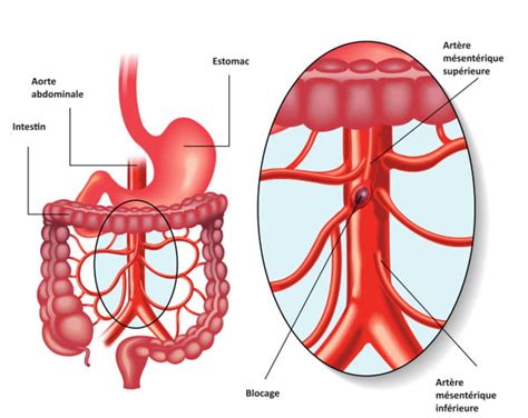 Comment arrive un infarctus mésentérique