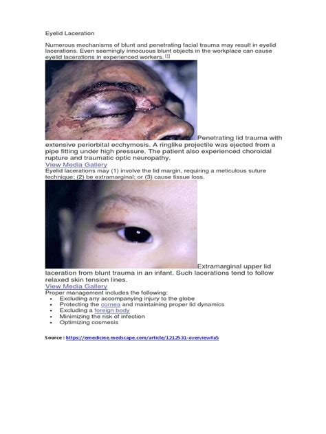 Eyelid Laceration | PDF