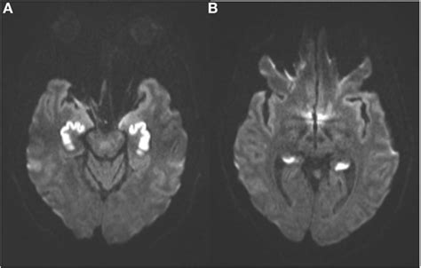 Frontiers Amnesia Associated With Bilateral Hippocampal And Bilateral