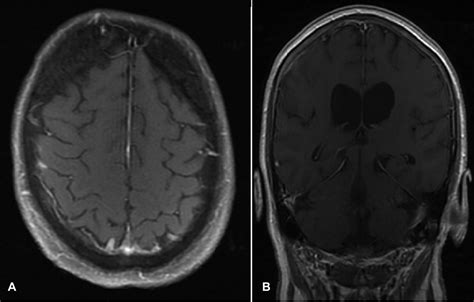 Schwannomas Mimicking Leptomeningeal Spread In The Setting Of Breast