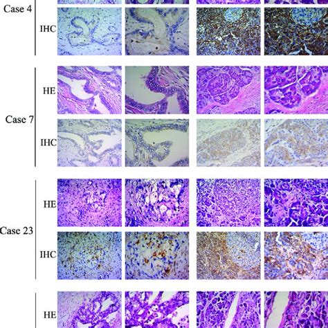 LITAF Protein Expression In Human Pancreatic Cancer LITAF Proteins