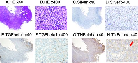 Case 28 Dlbcl Fibrosis And Fibroblast Stimulating Cytokines