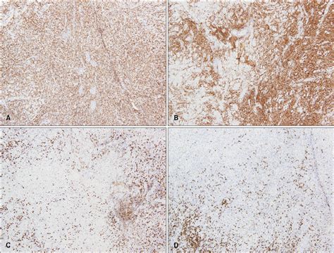 A Case Of Primary Cutaneous Cd4 Positive Small Medium T Cell Lymphoma