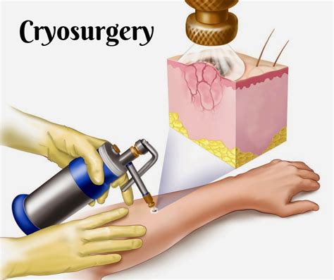 2nd World Congress on Surgeons: Cryosurgery