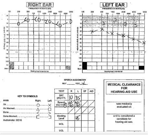 Pure Tone Audiogram Performed At First Office Visit Showing Normal