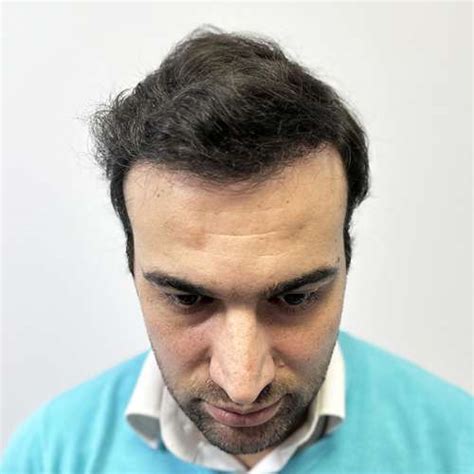 3810 Grafts Before After Dr Resul Yaman Hair Clinic