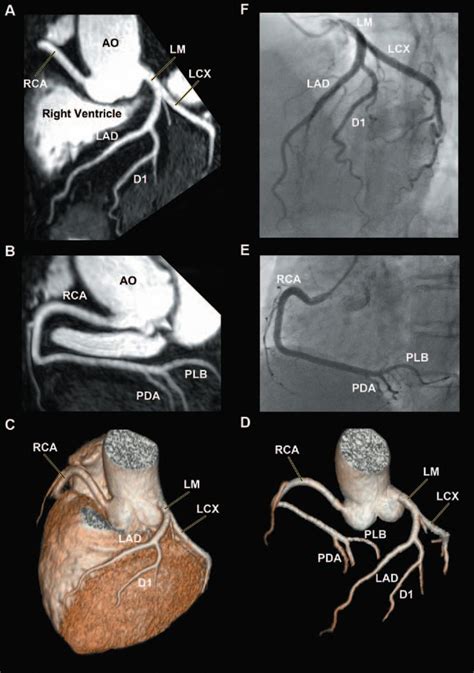 3 0T Whole Heart Coronary Magnetic Resonance Angiography Performed With