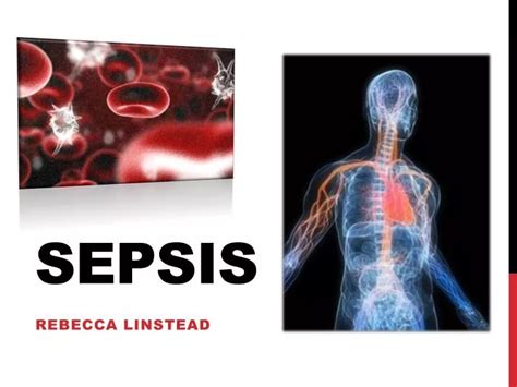 Ppt Sepsis Powerpoint Presentation Free Download Id 6920054