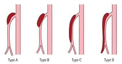 The Classification And Management Strategy Of Spontaneous Isolated