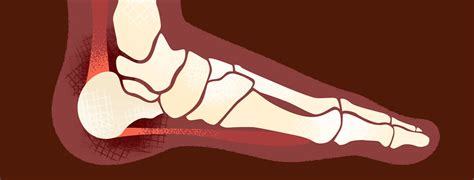 What Is The Connection Between Enthesitis And Psoriatic Arthritis