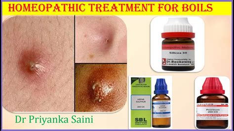 Homeopathy Treatment For Boil Fruncle Carbuncle Abscess Pus In Boil Hard Dr