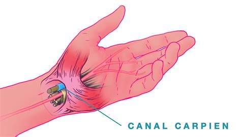 Syndrôme du canal carpien Hallux Valgus Nice Chirurgie pied Nice