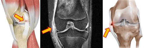 Ligamento Colateral Medial Do Cotovelo LIBRAIN