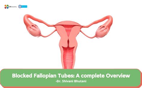 Blocked Fallopian Tubes A Complete Overview Eva Hospital