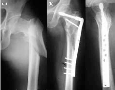 A Preoperative And B One Year Postoperative Radiographs Showing An