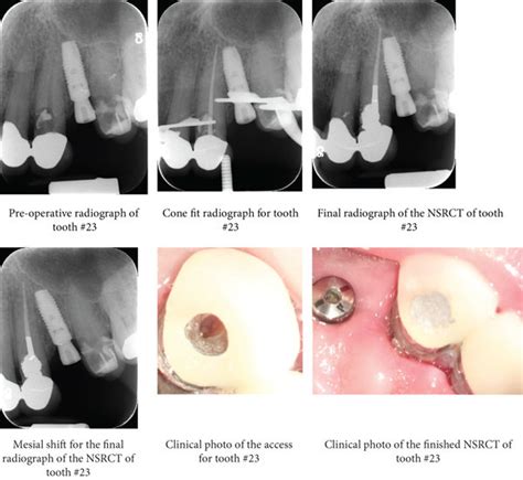 Radiographs And Clinical Photos Showing The Steps Of Nonsurgical Root