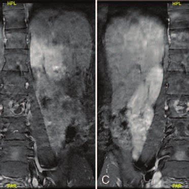 A D Preoperative Sagittal Mri Scan Revealing The Density Of Soft